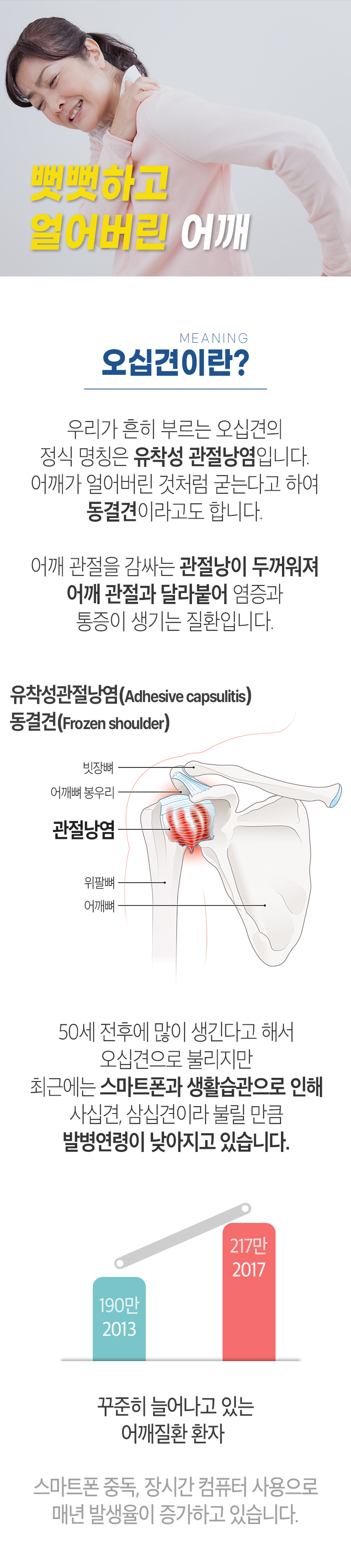 뻣뻣하고 얼어버린 어깨 MEANING 오십견이란? ▷ 우리가 흔히 부르는 오십견의 정식 명칭은 유착성 관절낭염입니다. 어깨가 얼어버린 것처럼 굳는다고 하여 동결견이라고도 합니다. 어깨 관절을 감싸는 관절낭이 두꺼워져 어깨 관절과 달라붙어 염증과 통증이 생기는 질환입니다. 유착성관절낭염(Adhesive capsulitis), 동결견(Frozen shoulder)  빗장뼈, 어깨뼈 봉우리, 관절낭염, 위팔뼈, 어깨뼈. 50세 전후에 많이 생긴다고 해서 오십견으로 불리지만 최근에는 스마트폰과 생활습관으로 인해 사십견, 삼십견이라 불릴 만큼 발병연령이 낮아지고 있습니다. 2013년 190만 → 2017년 217만. 꾸준히 늘어나고 있는 어깨질환 환자. 스마트폰 중독, 장시간 컴퓨터 사용으로 매년 발생율이 증가하고 있습니다.