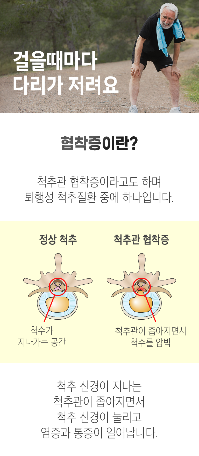 걸을때마다 다리가 저려요. 협착증이란? ▷ 척추관 협착증이라고도 하며 퇴행성 척추질환 중에 하나입니다. 정상척추 - 척수가 지나가는 공간이 있음. 척추관 협착증 - 척추관이 좁아지면서 척추를 압박. 척추 신경이 지나는 척추관이 좁아지면서 척추 신경이 눌리고 염증과 통증이 일어납니다.