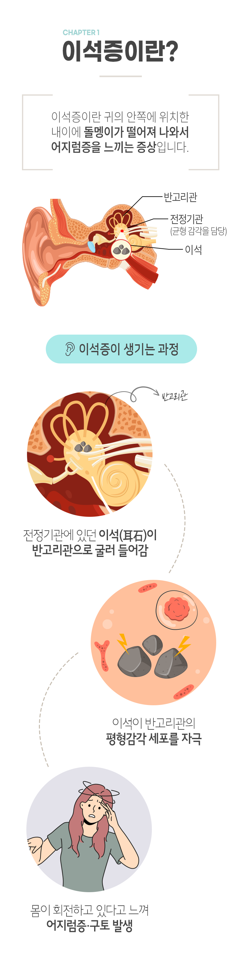 CHAPTER1 이석증이란? 이석증이란 귀의 안쪽에 위치한 내이에 돌멩이가 떨어져 나와서 어지럼증을 느끼는 증상입니다. 귀 안쪽 제일 윗부분 - 반고리관, 바로 아래에 전정기관(균형 감각을 담당), 거기에서 떨어져 나오는 돌멩이가 이석. 이석증이 생기는 과정- 전정기관에 있던 이석이 반고리관으로 굴러 들어감 → 이석이 반고리관의 평형감각 세포를 자극 → 몸이 회전하고 있다고 느껴 어지럼증·구토 발생