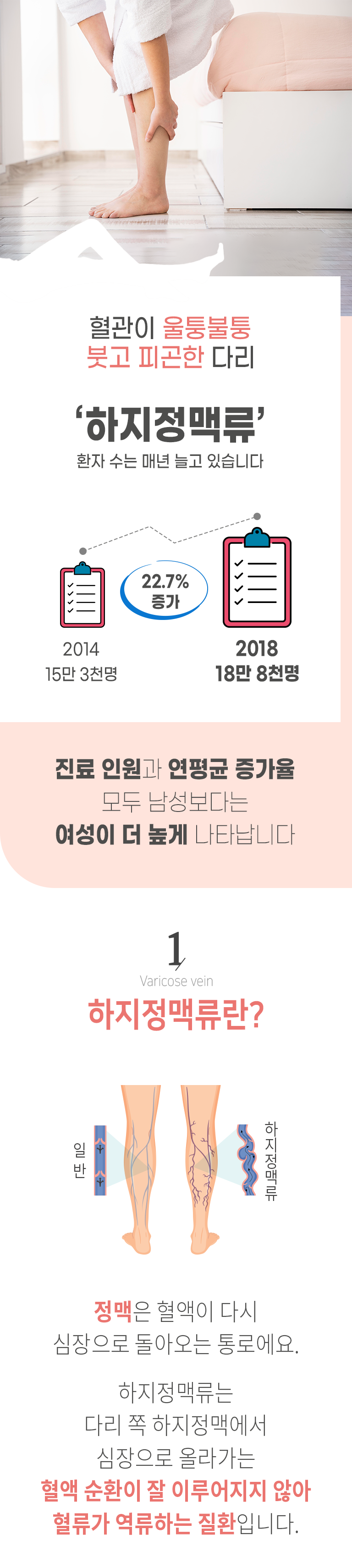 혈관이 울퉁불퉁 붓고 피곤한 다리 '하지정맥류' 환자 수는 매년 늘고 있습니다. 2014년 15만 3천명, 2018년 18만 8천명으로 22.7% 증가. 진료 인원과 연평균 증가율 모두 남성보다는 여성이 더 높게 나타납니다. 1. Varicose vein 하지정맥류란? 정맥은 혈액이 다시 심장으로 돌아오는 통로에요. 하지정맥류는 다리 쪽 하지정맥에서 심장으로 올라가는 혈액 순환이 잘 이루어지지 않아 혈류가 역류하는 질환입니다.
