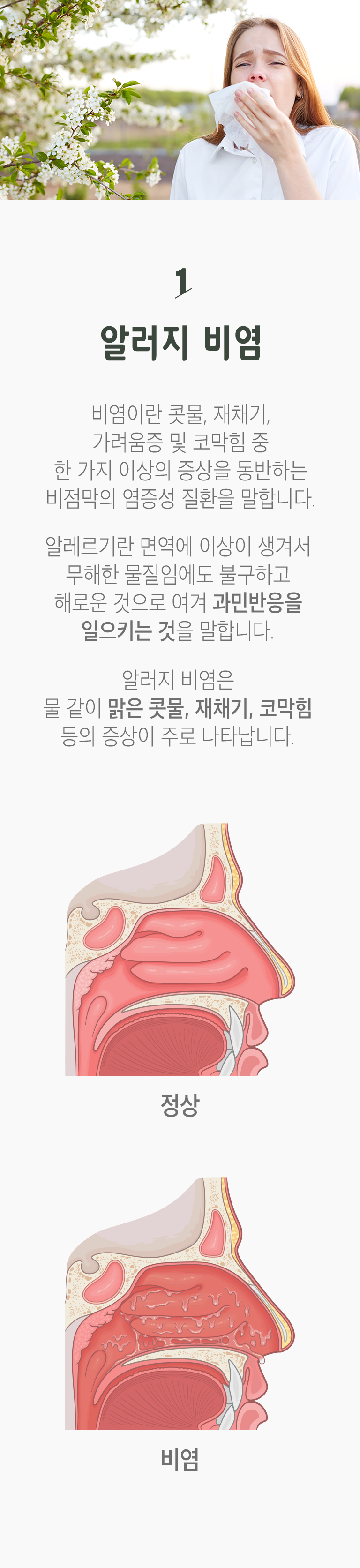 01 알러지 비염 ▷ 비염이란 콧물, 재채기, 가려움증 및 코막힘 중 한 가지 이상의 증상을 동반하는 비점막의 염증성 질환을 말합니다. 알레르기란 면역에 이상이 생겨서 무해한 물질임에도 불구하고 해로운 것으로 여겨 과민반응을 일으키는 것을 말합니다. 알러지 비염은 물 같이 맑은 콧물, 재채기, 코막힘 등의 증상이 주로 나타납니다.