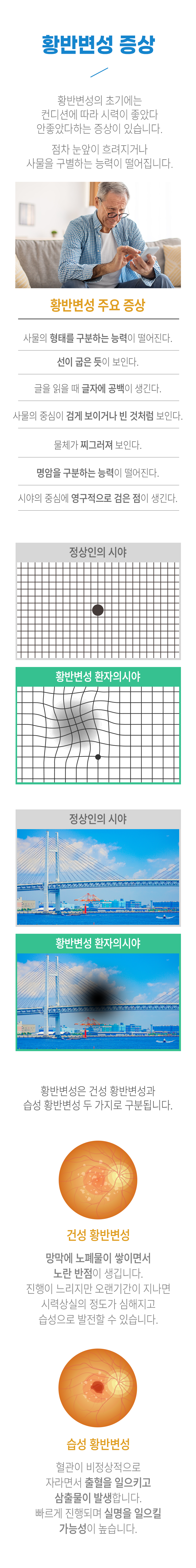 황반변성 증상 ▷ 황반변성의 초기에는 컨디션에 따라 시력이 좋았다 안좋았다하는 증상이 있습니다. 점차 눈앞이 흐려지거나 사물을 구별하는 능력이 떨어집니다. 황반변성 주요 증상 - 사물의 형태를 구분하는 능력이 떨어진다. 선이 굽은 듯이 보인다. 글을 읽을 때 글자에 공백이 생긴다. 사물의 중심이 검게 보이거나 빈 것처럼 보인다. 물체가 찌그러져 보인다. 명암을 구분하는 능력이 떨어진다. 시야의 중심에 영구적으로 검은 점이 생긴다. 황반변성은 건성 황반변성과 습성 황반변성 두 가지로 구분됩니다. 건성 황반변성 - 망막에 노폐물이 쌓이면서 노란 반점이 생깁니다. 진행이 느리지만 오랜기간이 지나면 시력상실의 정도가 심해지고 습성으로 발전할 수 있습니다. 습성 황반변성 - 혈관이 비정상적으로 자라면서 출혈을 일으키고 삼출물이 발생합니다. 빠르게 진행되며 실명을 일으킬 가능성이 높습니다.