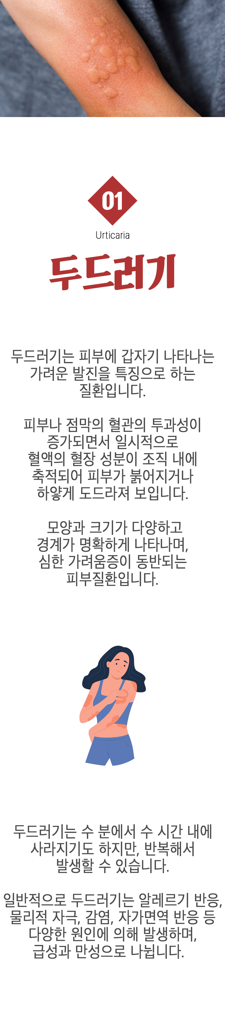 한번 발생하면 수시간 동안 가려운 두드러기. 두드러기란? 벌레 물렸을 때처럼 부풀어 오르는 증상이 특징으로 피부가 몹시 가렵고, 경계가 명확하게 홍색 또는 흰색으로 부어오릅니다. 두드러기는 아주 흔한 피부질환으로 전 인구의 약 20%가 일생에 한 번 이상 두드러기를 경험합니다. 발생 시기에 따른 두드러기 종류 ▷ 급성 두드러기 - 대부분 일주일 내에 소실된다. - 음식물, 약물이나 감염 등이 원인. 만성 두드러기 - 6주 이상 반복적으로 나타난다. - 특발성이거나 자가면역기전에 의해 발생한다.