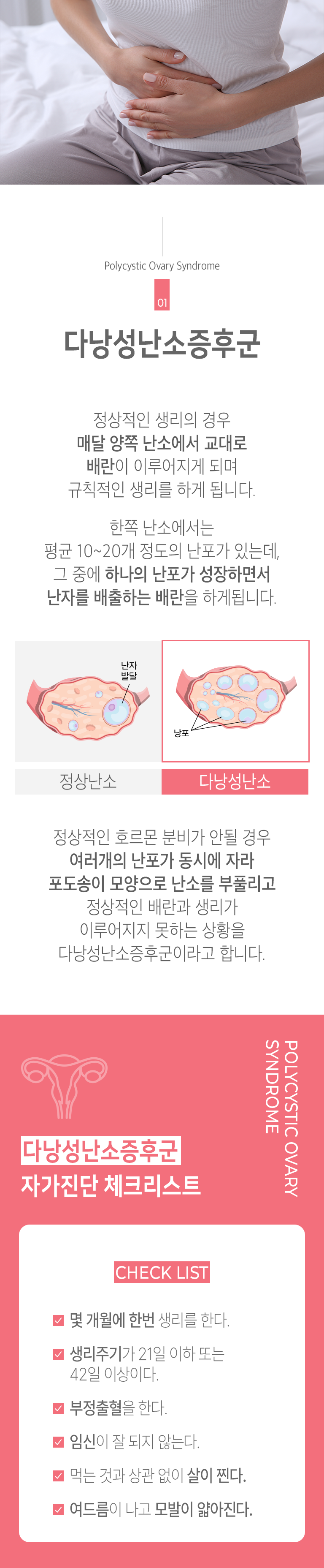 01 다낭성난소증후군 ▷ 정상적인 생리의 경우 매달 양쪽 난소에서 교대로 배란이 이루어지게 되며 규칙적인 생리를 하게 됩니다. 한쪽 난소에서는 평균 10~20개 정도의 난포가 있는데 그 중에 하나의 난포가 성장하면서 난자를 배출하는 배란을 하게 됩니다. 정상적인 호르몬 분비가 안될 경우 여러개의 난포가 동시에 자라 포도송이 모양으로 난소를 부풀리고 정상적인 배란과 생리가 이루어지지 못하는 상황을 다낭성난소증후군이라고 합니다. 다낭성난소증후군 자가진단 체크리스트 CHECK LIST ▶ □ 몇 개월에 한 번 생리를 한다. □ 생리주기가 21일 이하 또는 42일 이상이다. □ 부정출혈을 한다. □ 임신이 잘 되지 않는다. □ 먹는 것과 상관 없이 살이 찐다. □ 여드름이 나고 모발이 얇아진다.